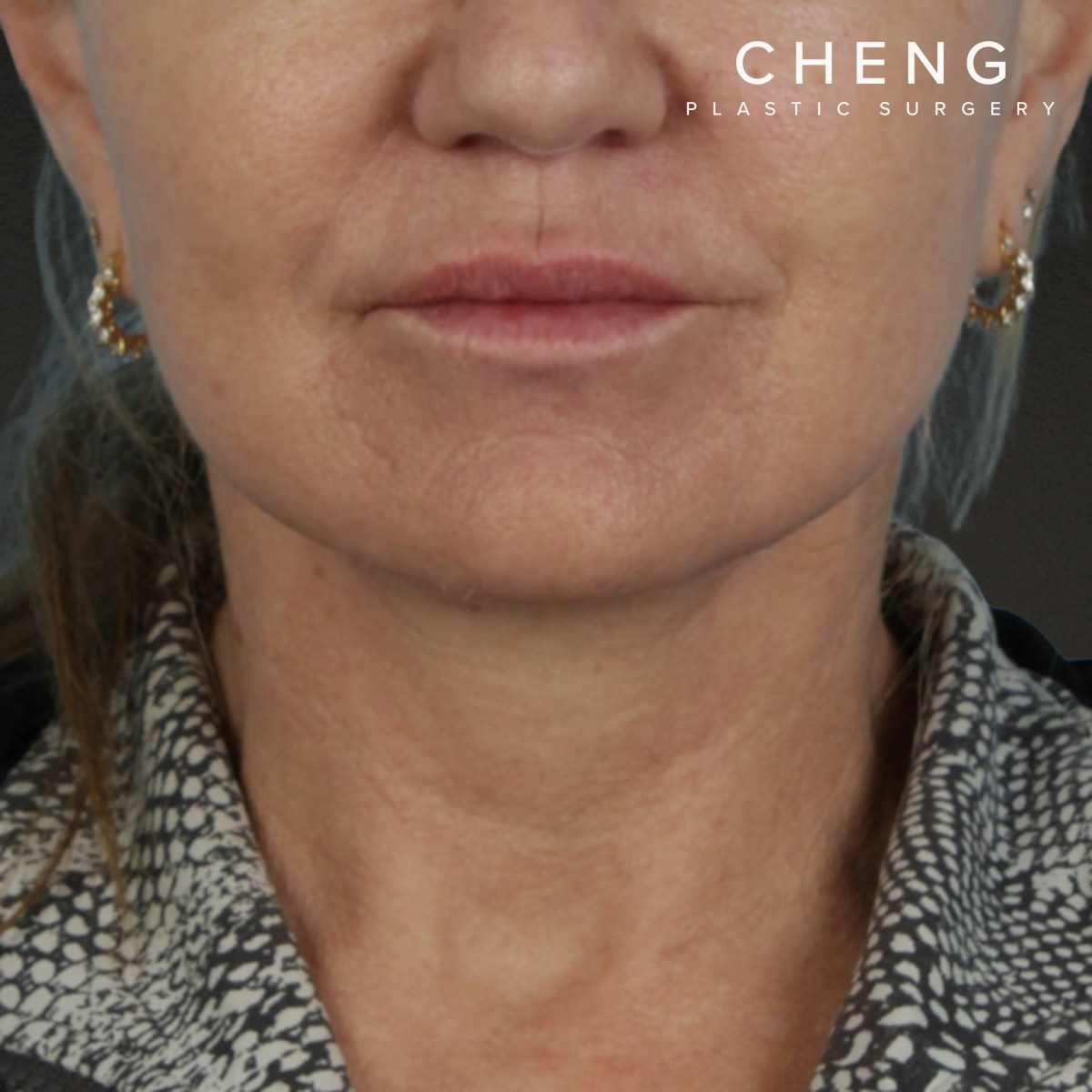 Facelift Before & After Gallery - Patient 315359 - Image 2