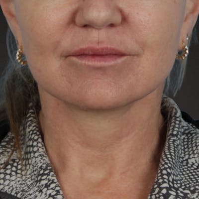 Facelift Before & After Gallery - Patient 315359 - Image 2