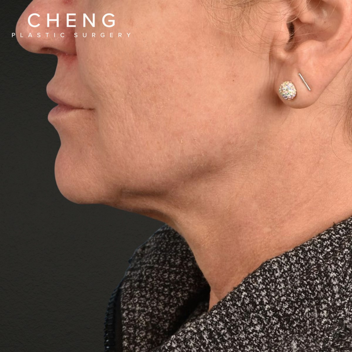 Facelift Before & After Gallery - Patient 315359 - Image 9