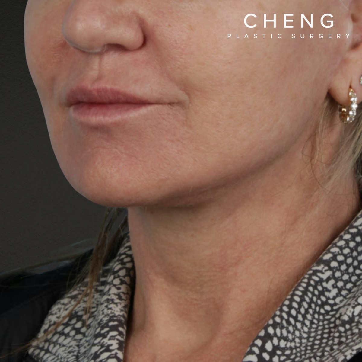 Facelift Before & After Gallery - Patient 315359 - Image 8