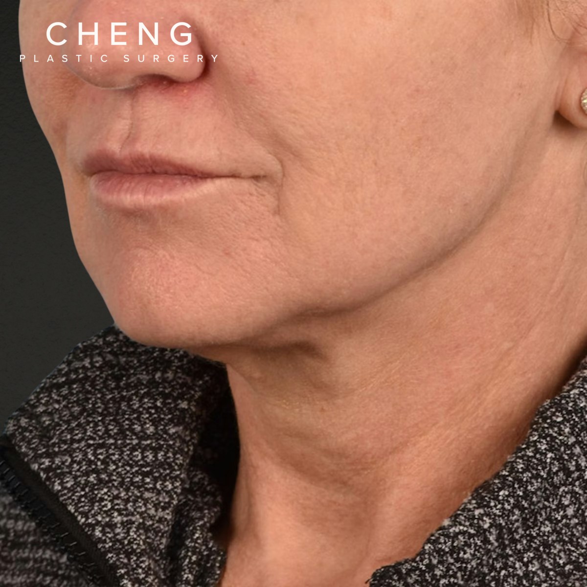 Facelift Before & After Gallery - Patient 315359 - Image 7