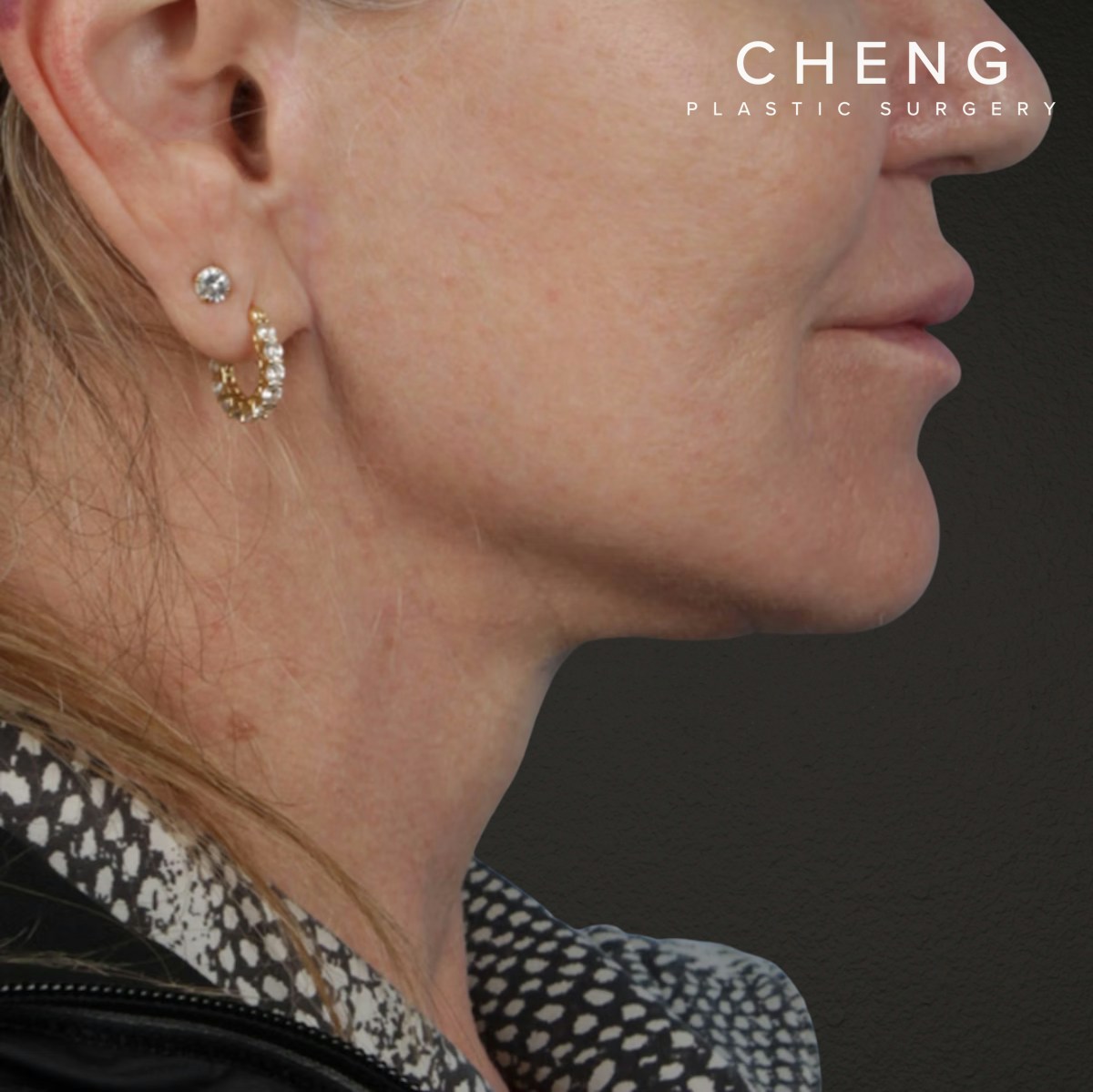 Facelift Before & After Gallery - Patient 315359 - Image 6