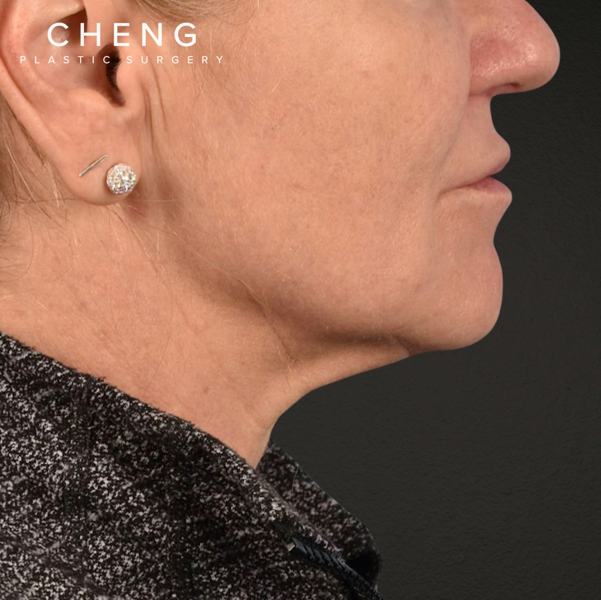 Facelift Before & After Gallery - Patient 315359 - Image 5