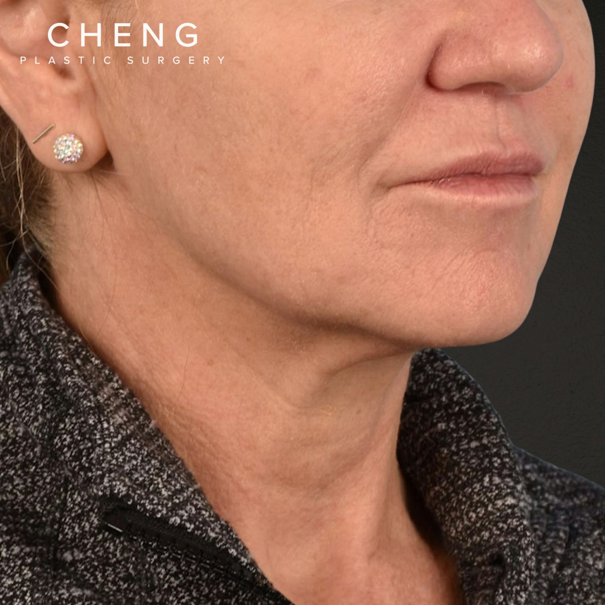 Facelift Before & After Gallery - Patient 315359 - Image 3