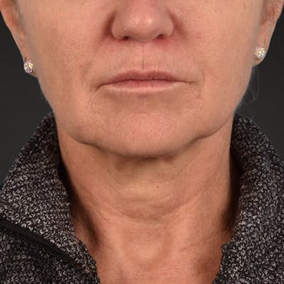 Facelift Before & After Gallery - Patient 315359 - Image 1