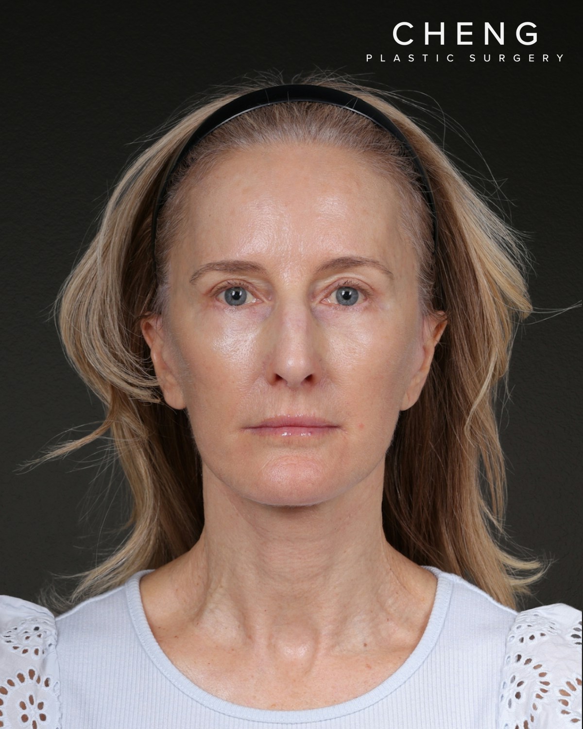 Facelift Before & After Gallery - Patient 401503 - Image 6