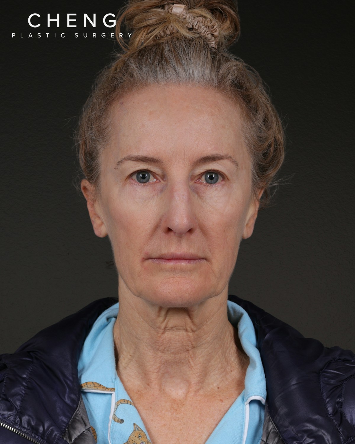 Facelift Before & After Gallery - Patient 401503 - Image 5