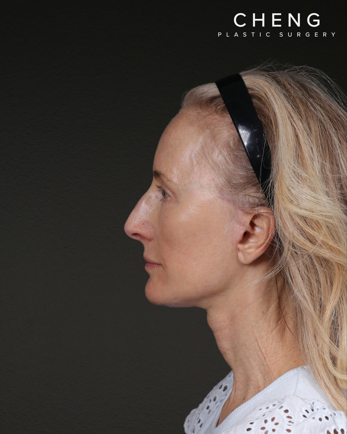 Facelift Before & After Gallery - Patient 401503 - Image 10