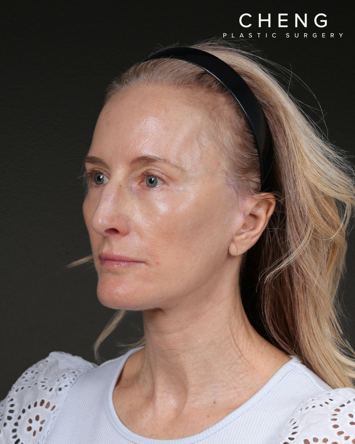 Facelift Before & After Gallery - Patient 401503 - Image 8