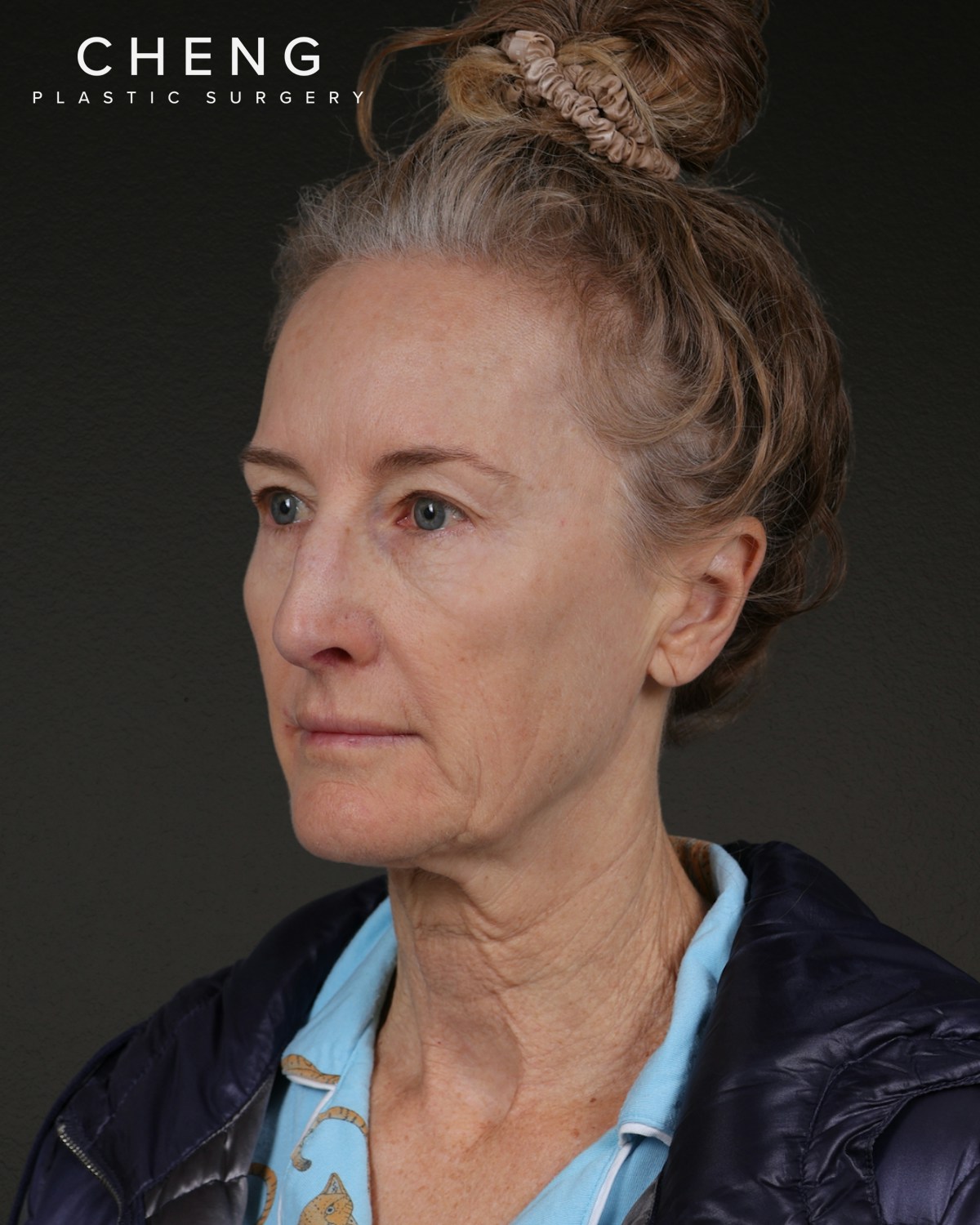 Facelift Before & After Gallery - Patient 401503 - Image 7