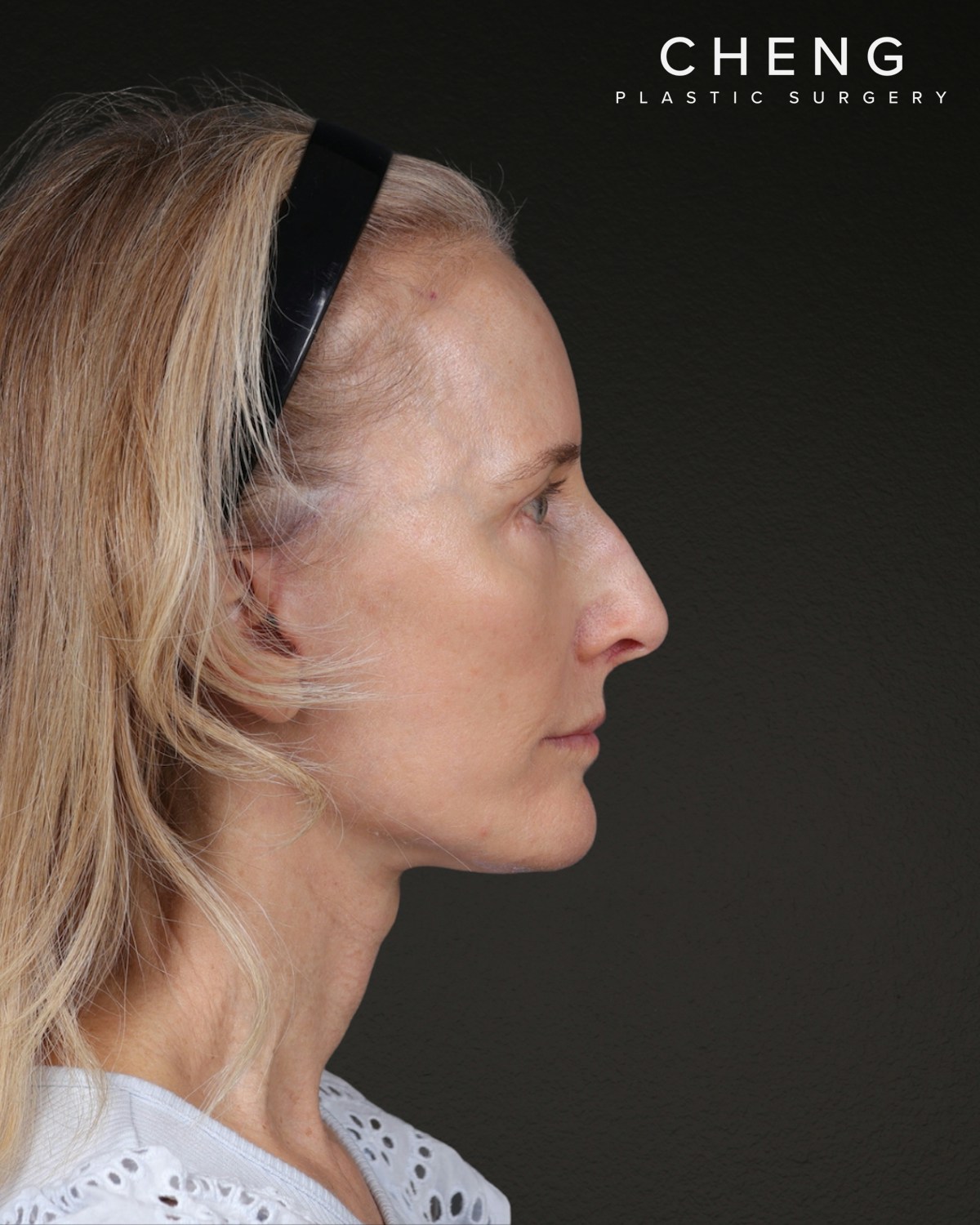 Facelift Before & After Gallery - Patient 401503 - Image 4