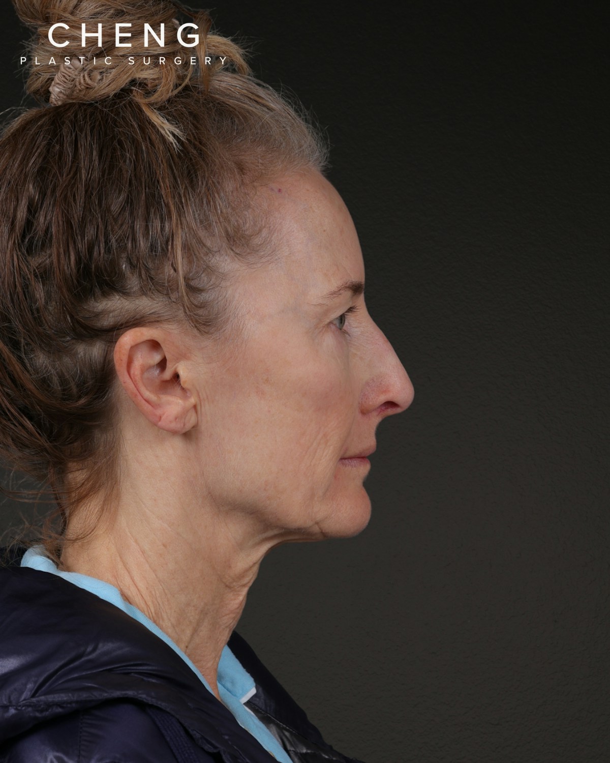 Facelift Before & After Gallery - Patient 401503 - Image 3