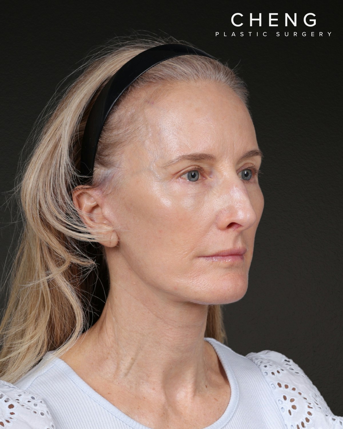 Facelift Before & After Gallery - Patient 401503 - Image 2