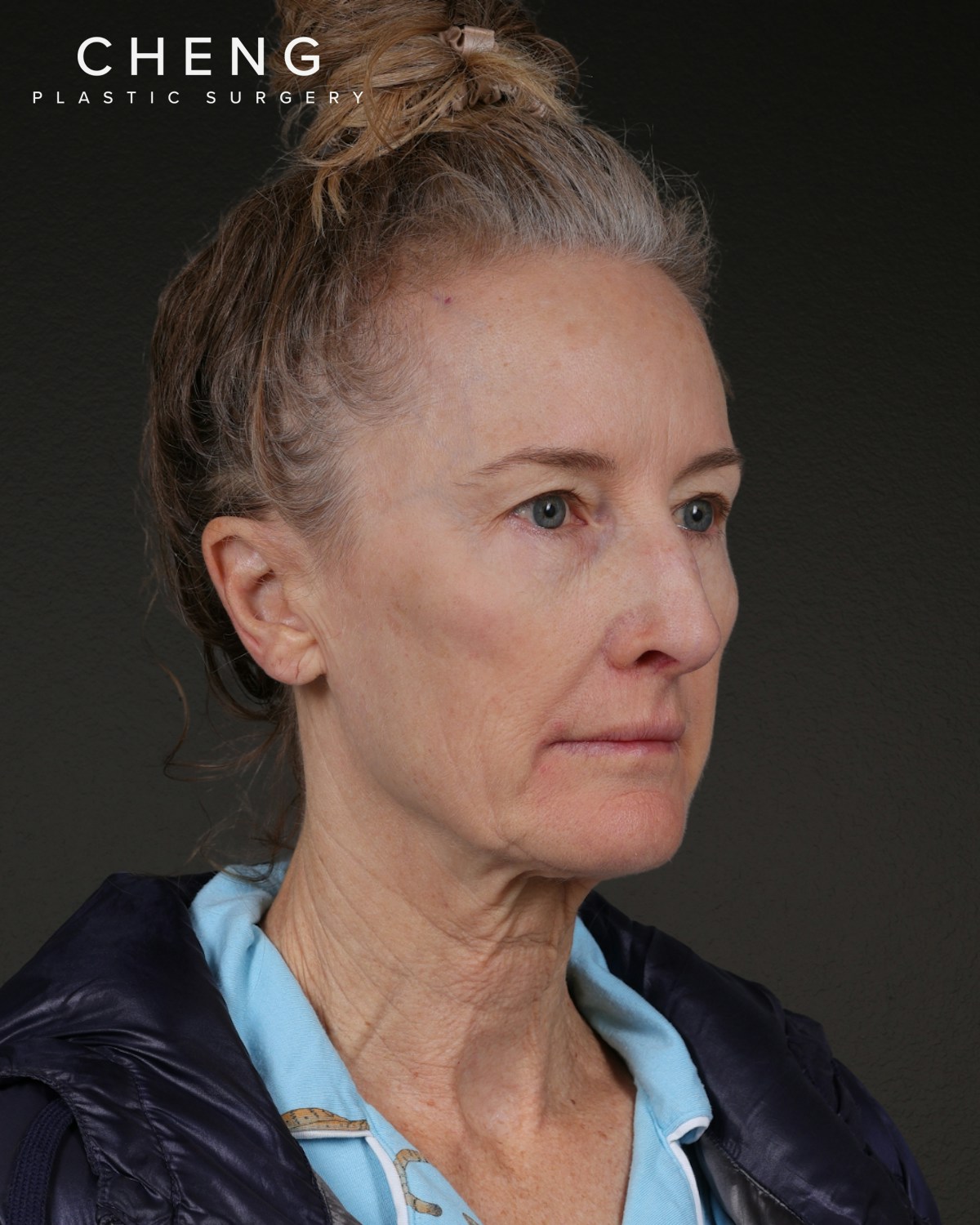 Facelift Before & After Gallery - Patient 401503 - Image 1