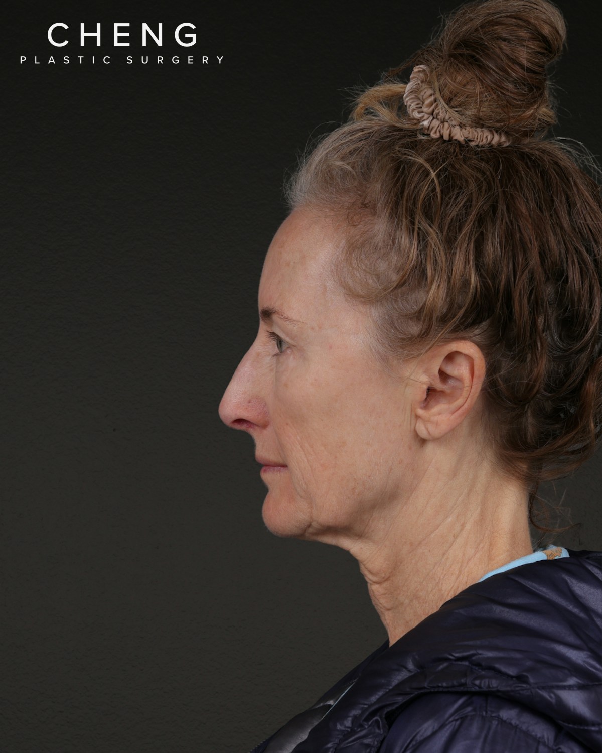 Facelift Before & After Gallery - Patient 401503 - Image 9