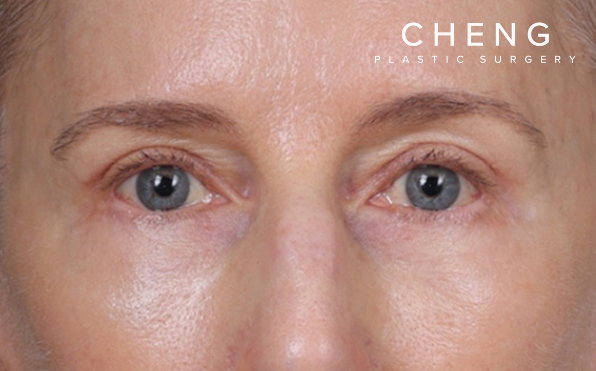 Brow Lift Before & After Gallery - Patient 123386 - Image 2