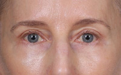 Brow Lift Before & After Gallery - Patient 123386 - Image 2