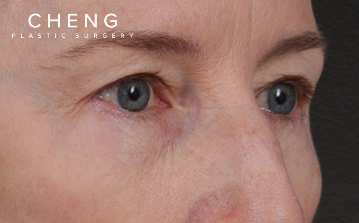 Brow Lift Before & After Gallery - Patient 123386 - Image 3