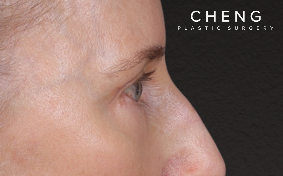 Brow Lift Before & After Gallery - Patient 123386 - Image 6