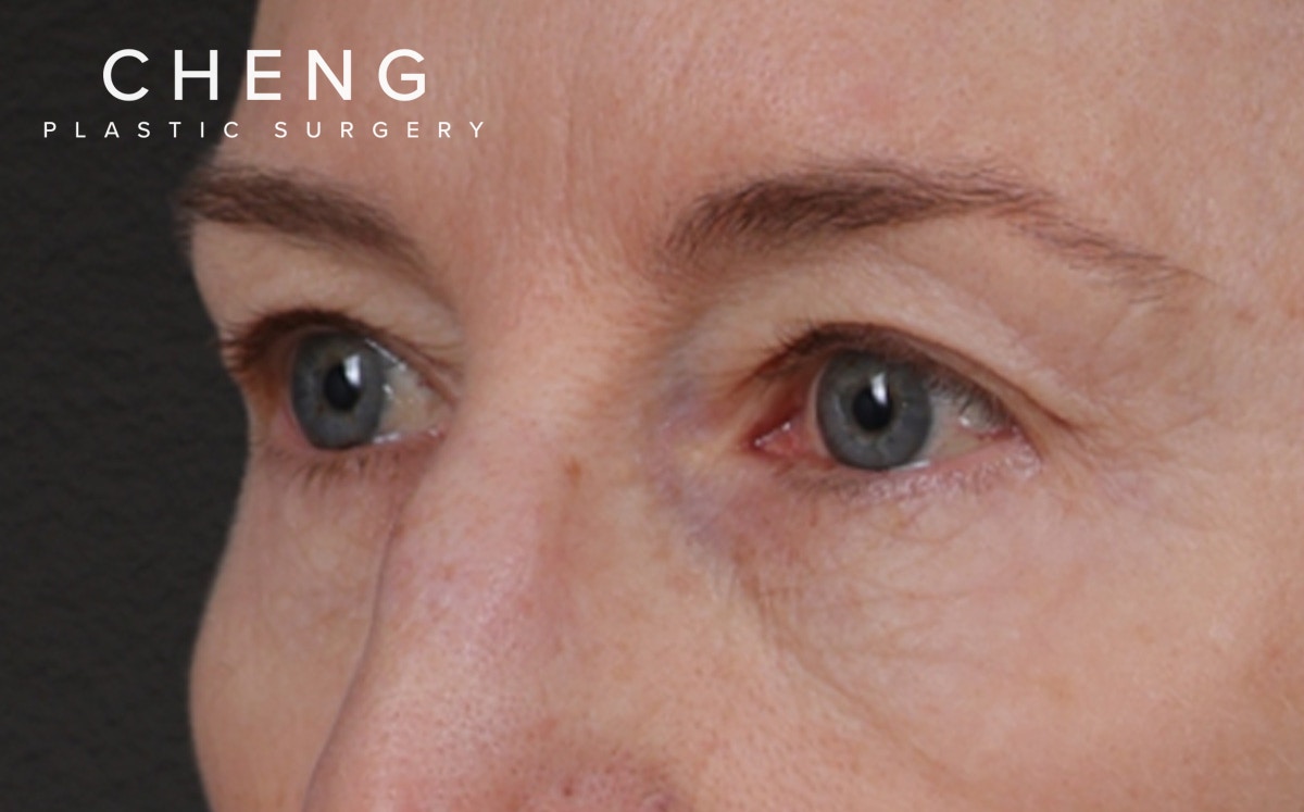 Brow Lift Before & After Gallery - Patient 123386 - Image 7