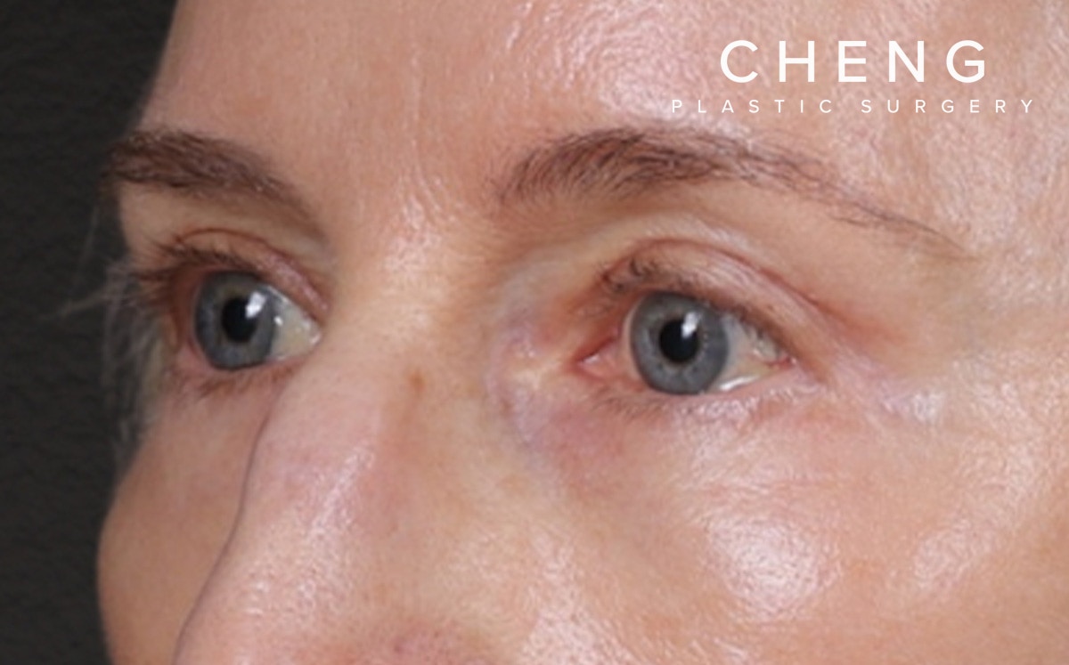 Brow Lift Before & After Gallery - Patient 123386 - Image 8
