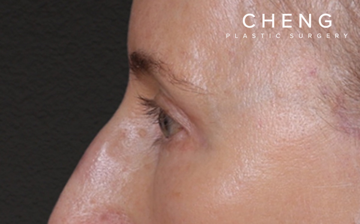 Brow Lift Before & After Gallery - Patient 123386 - Image 10