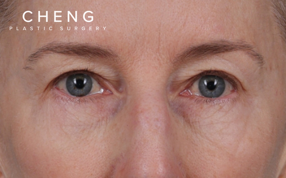 Brow Lift Before & After Gallery - Patient 123386 - Image 1