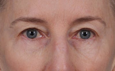 Brow Lift Before & After Gallery - Patient 123386 - Image 1