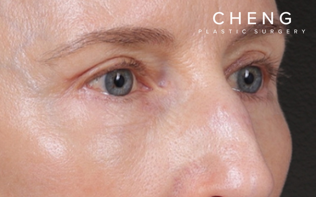 Brow Lift Before & After Gallery - Patient 123386 - Image 4