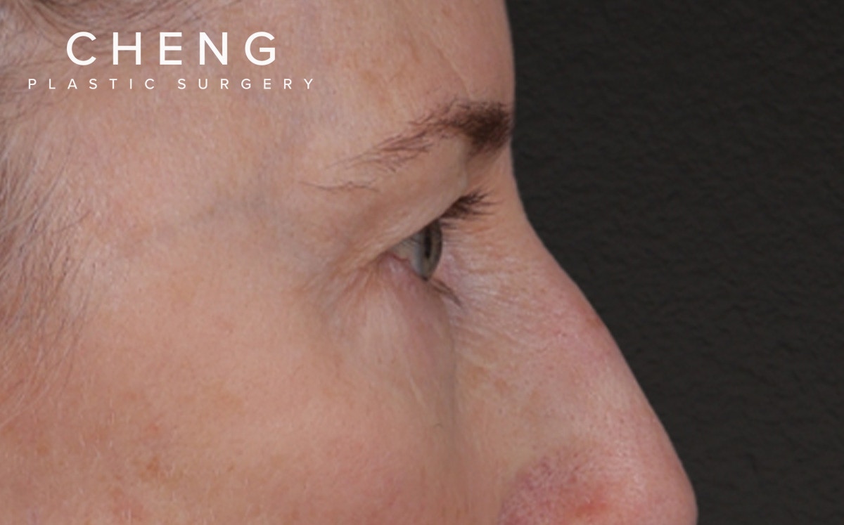 Brow Lift Before & After Gallery - Patient 123386 - Image 5
