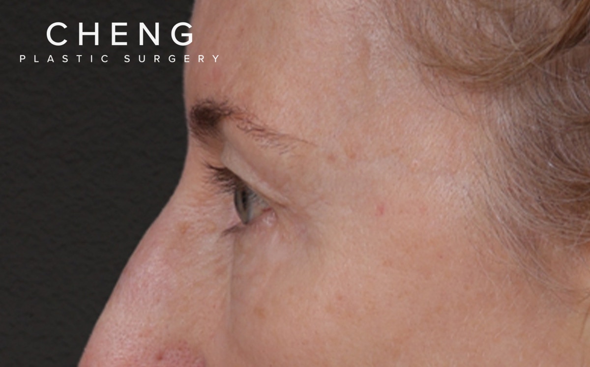 Brow Lift Before & After Gallery - Patient 123386 - Image 9
