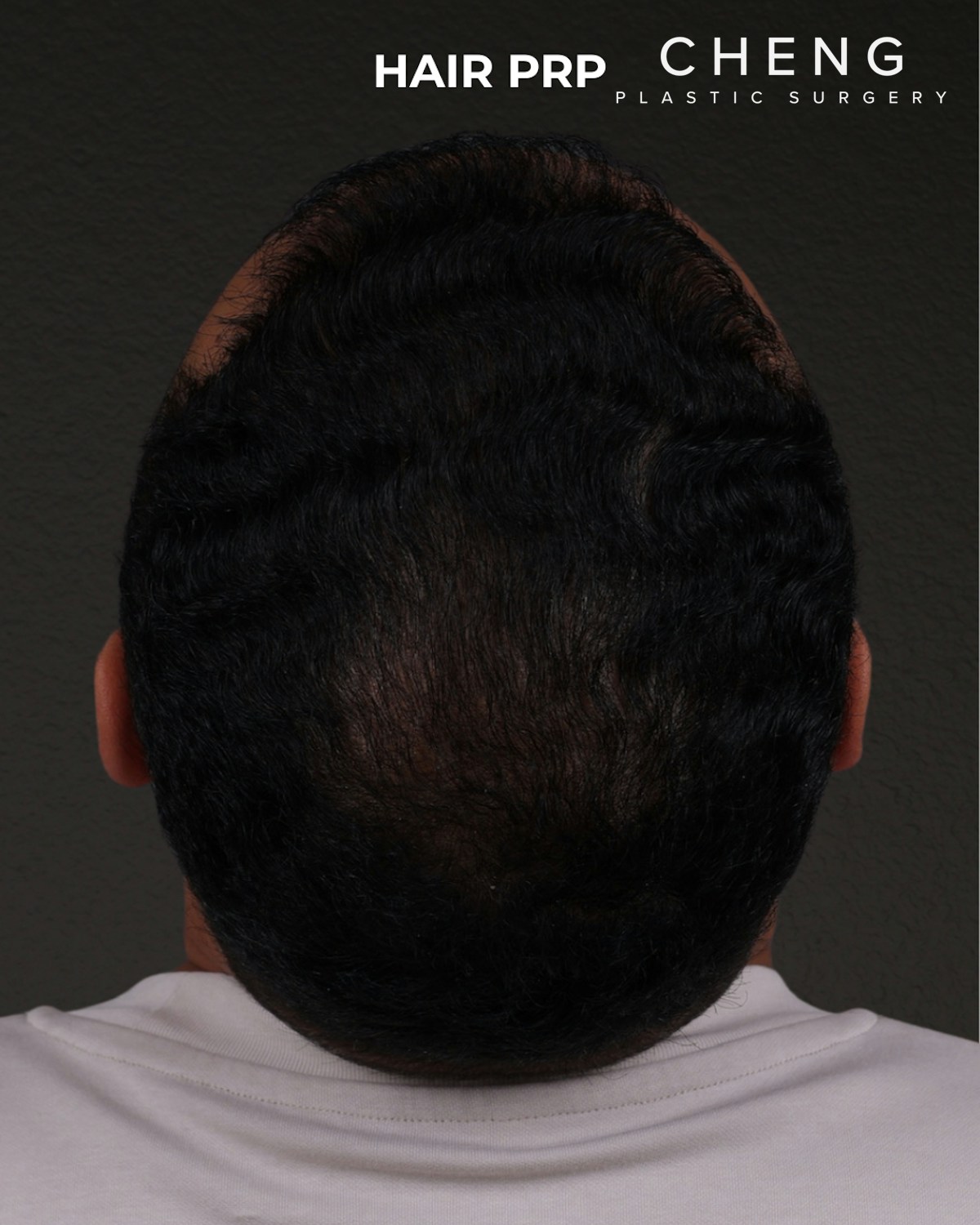 Hair Rejuvenation With PRP Before & After Gallery - Patient 233027 - Image 2