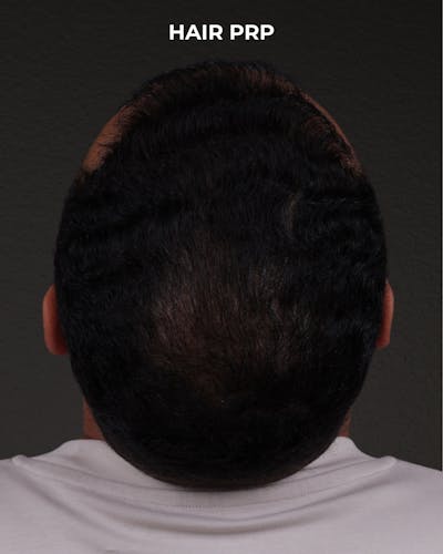 Hair Rejuvenation With PRP Before & After Gallery - Patient 233027 - Image 2