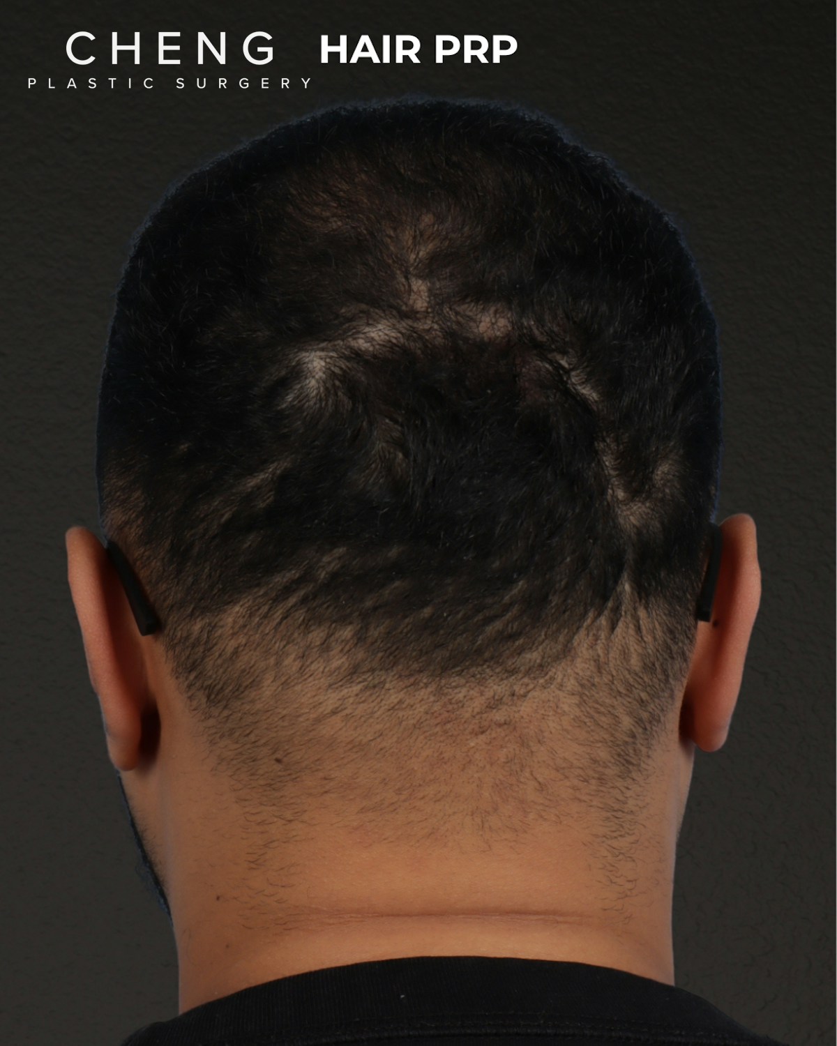 Hair Rejuvenation With PRP Before & After Gallery - Patient 233027 - Image 1