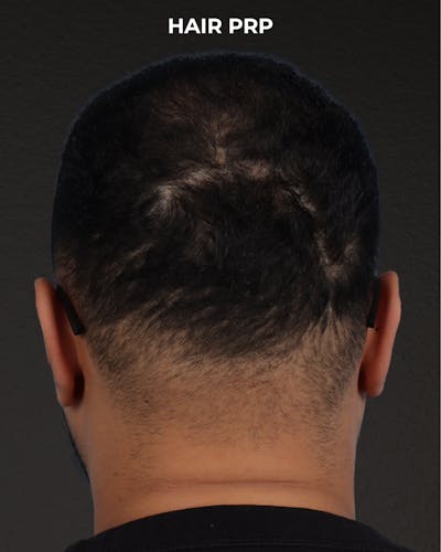Hair Rejuvenation With PRP Before & After Gallery - Patient 233027 - Image 1
