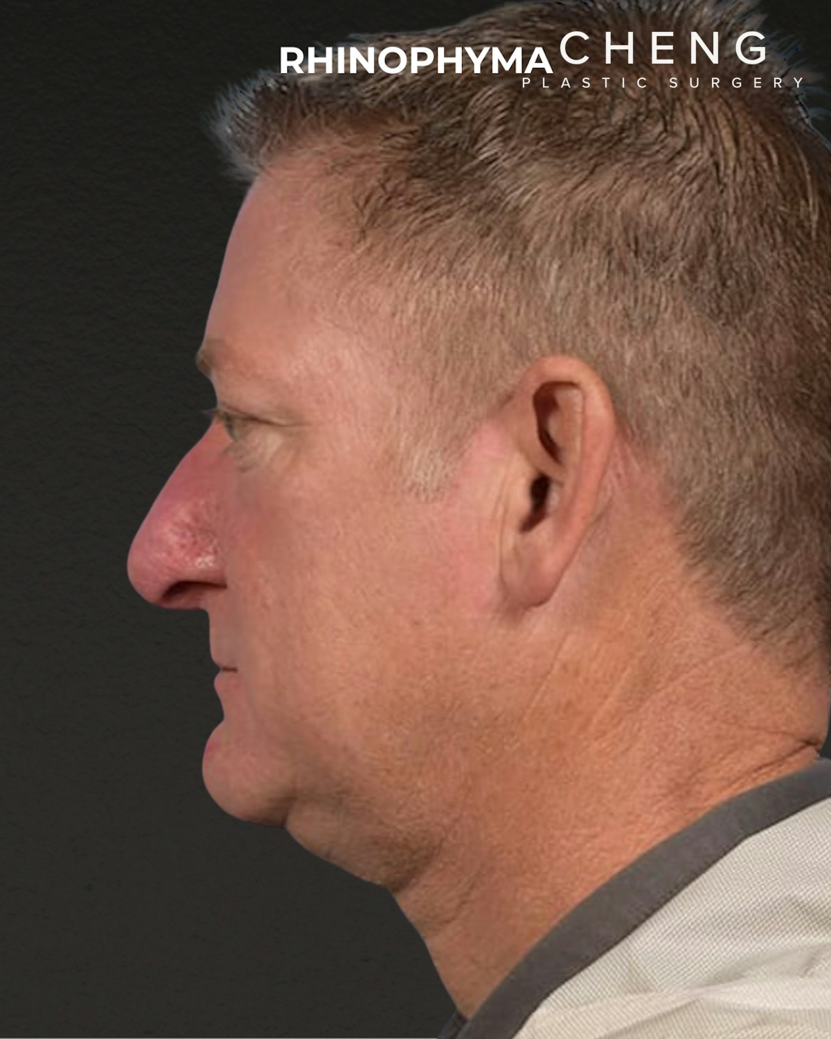 Rhinoplasty Before & After Gallery - Patient 236748 - Image 2