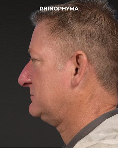 Rhinoplasty Before & After Gallery - Patient 236748 - Image 2