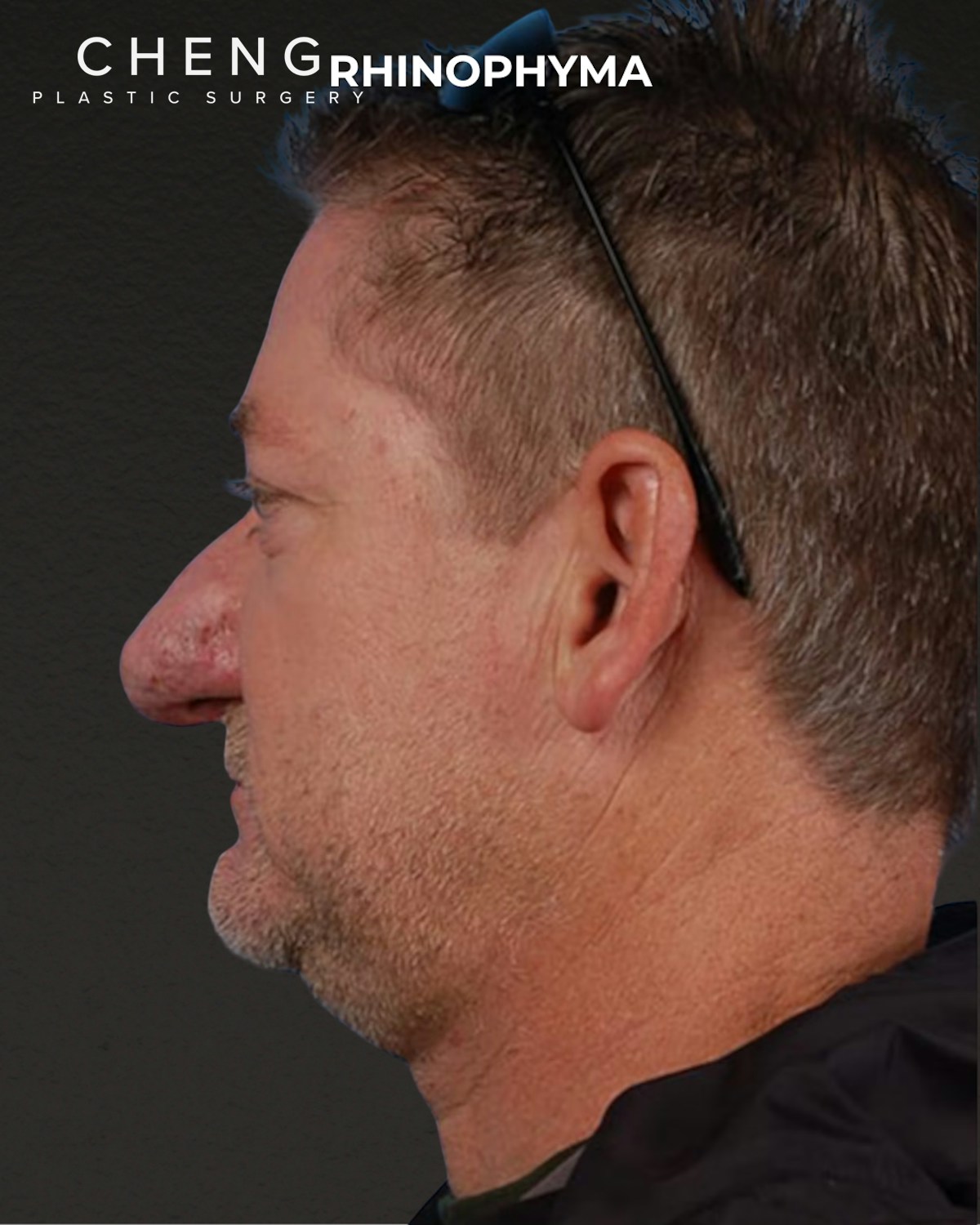 Rhinoplasty Before & After Gallery - Patient 236748 - Image 1