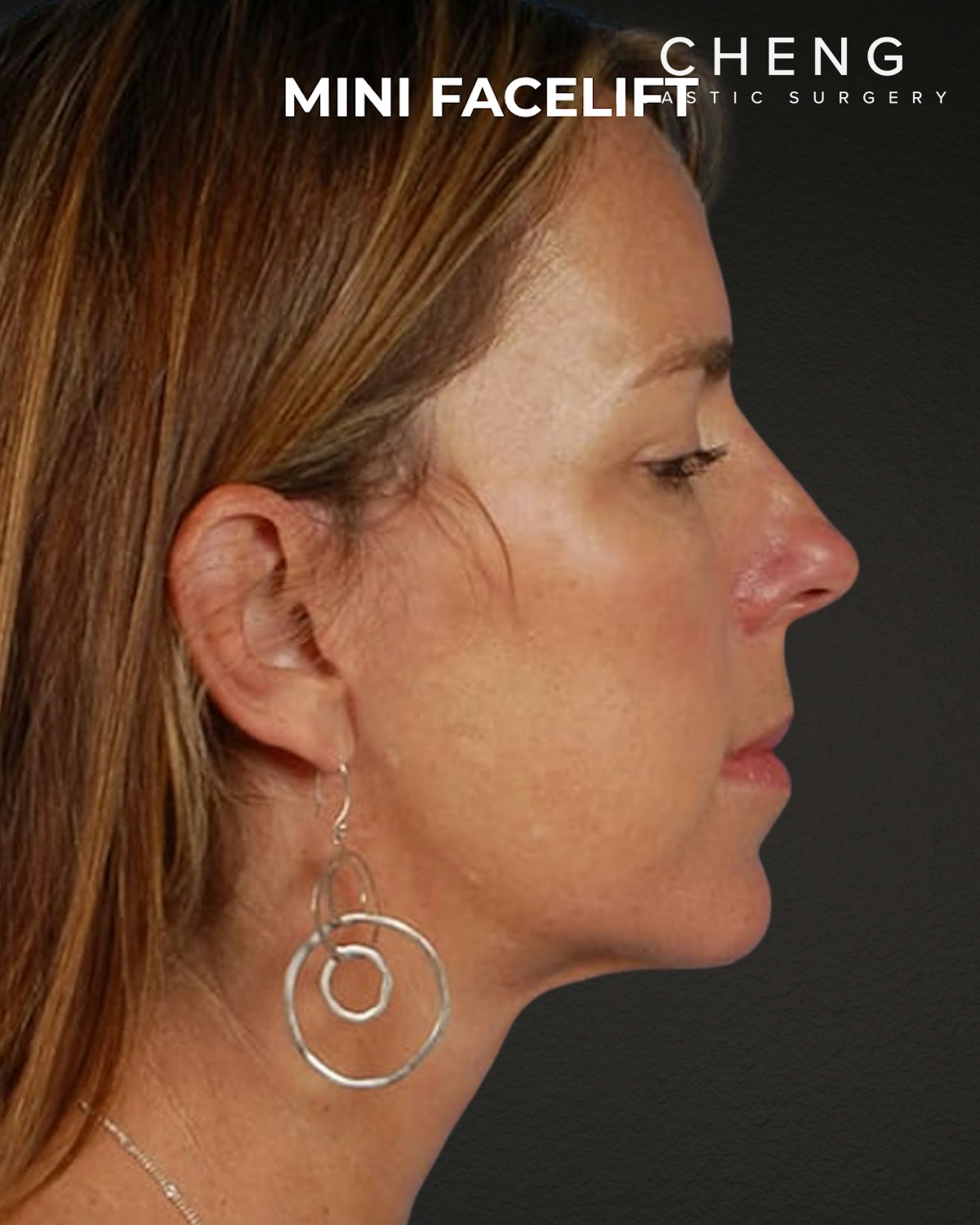 Facelift Before & After Gallery - Patient 244293 - Image 2