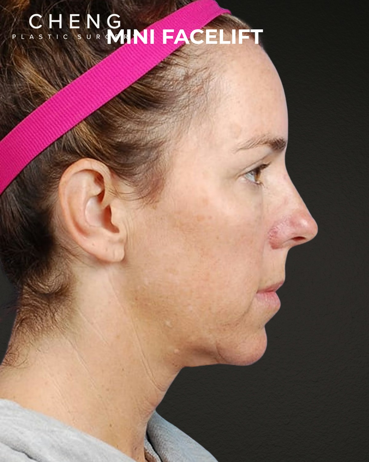 Facelift Before & After Gallery - Patient 244293 - Image 1