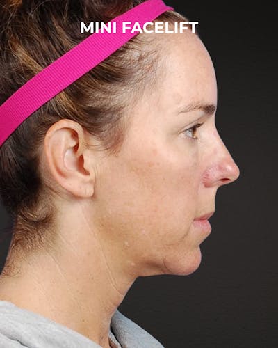 Facelift Before & After Gallery - Patient 244293 - Image 1