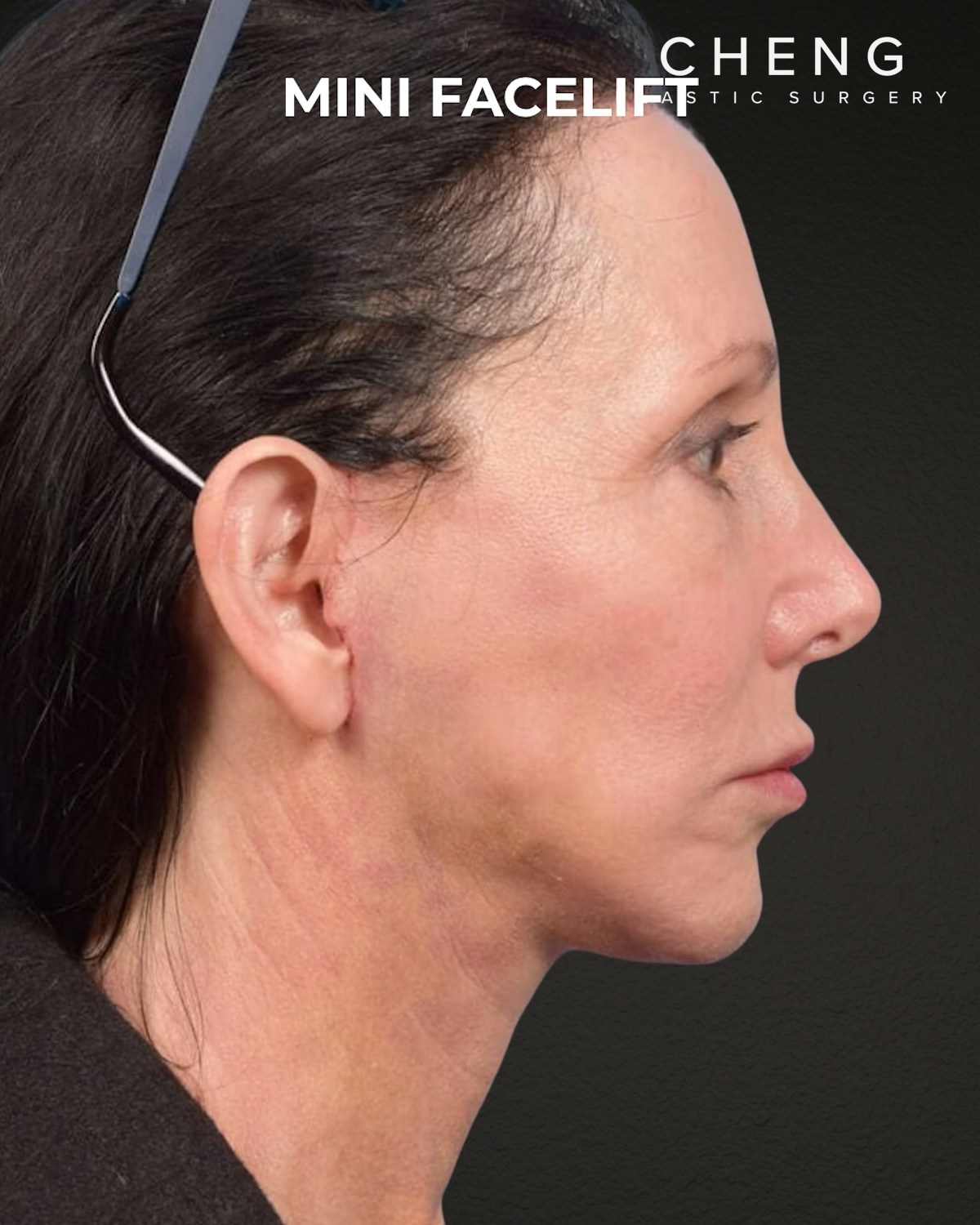 Facelift Before & After Gallery - Patient 325352 - Image 2