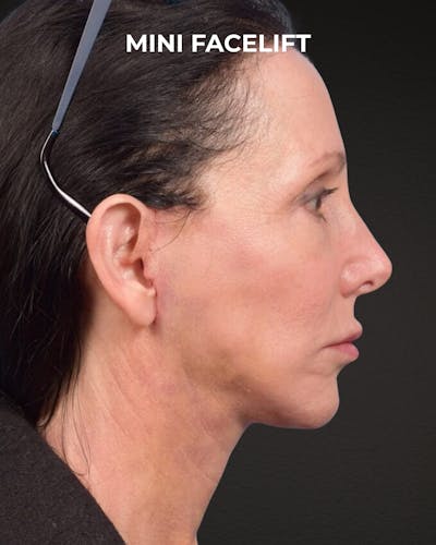 Facelift Before & After Gallery - Patient 325352 - Image 2