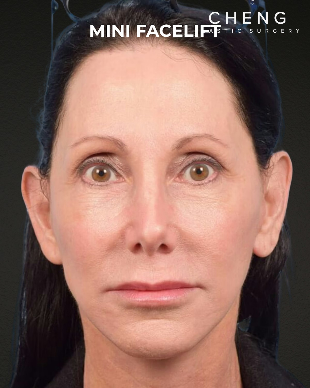 Facelift Before & After Gallery - Patient 325352 - Image 6