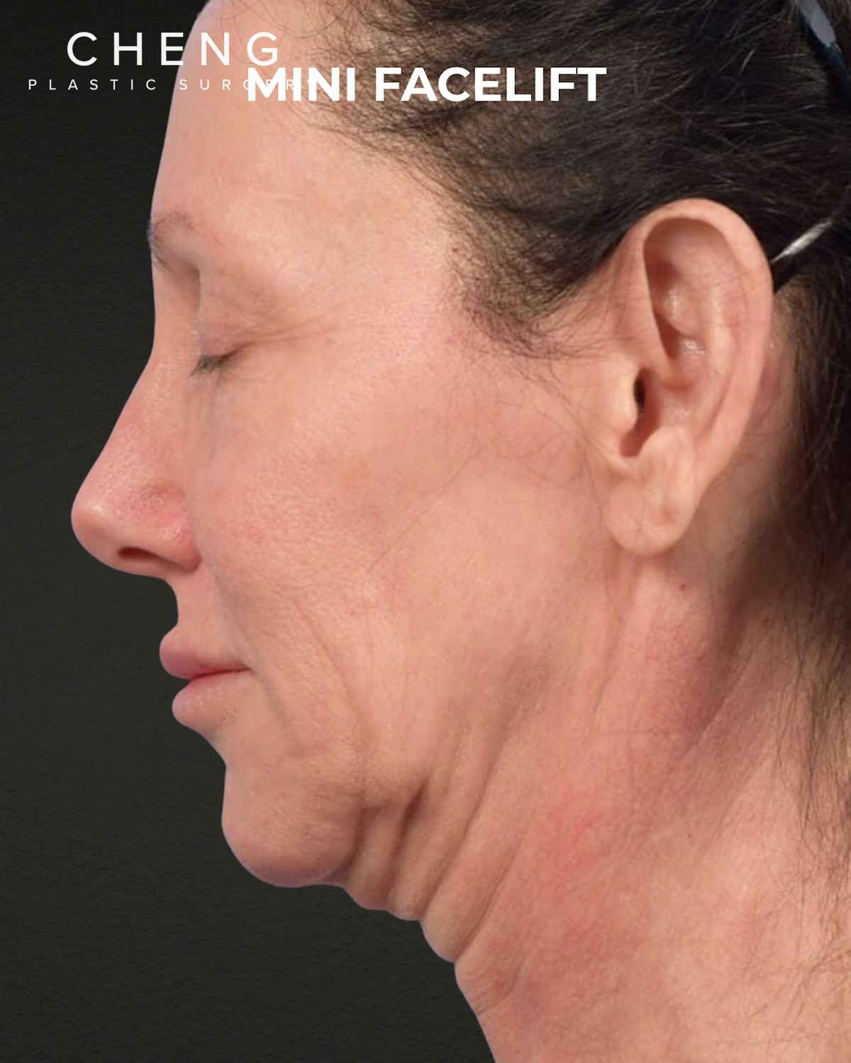 Facelift Before & After Gallery - Patient 325352 - Image 3