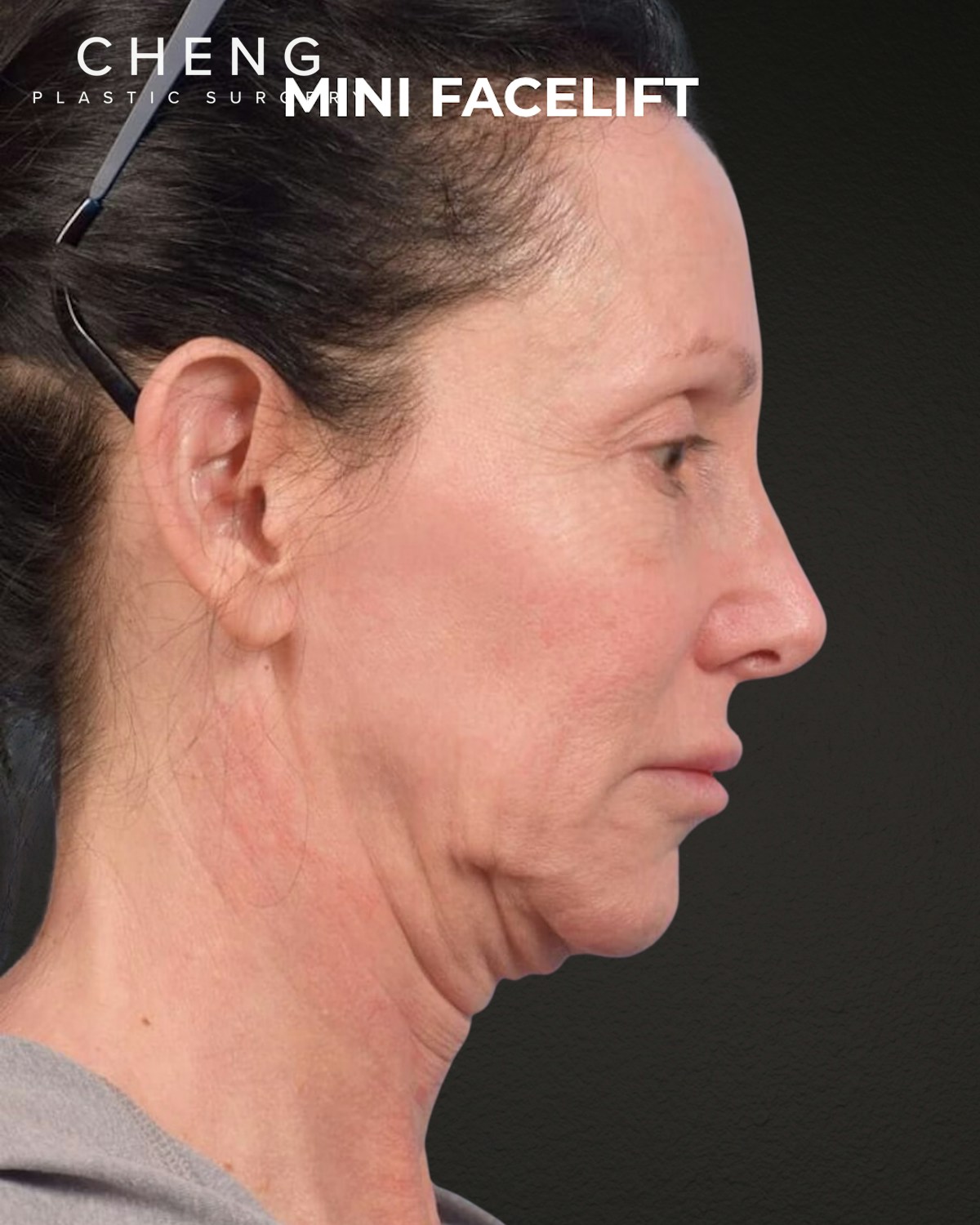 Facelift Before & After Gallery - Patient 325352 - Image 1