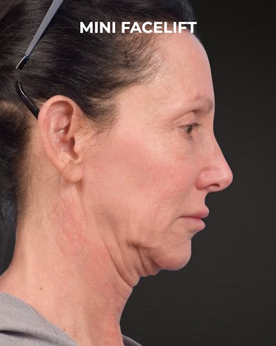 Facelift Before & After Gallery - Patient 325352 - Image 1