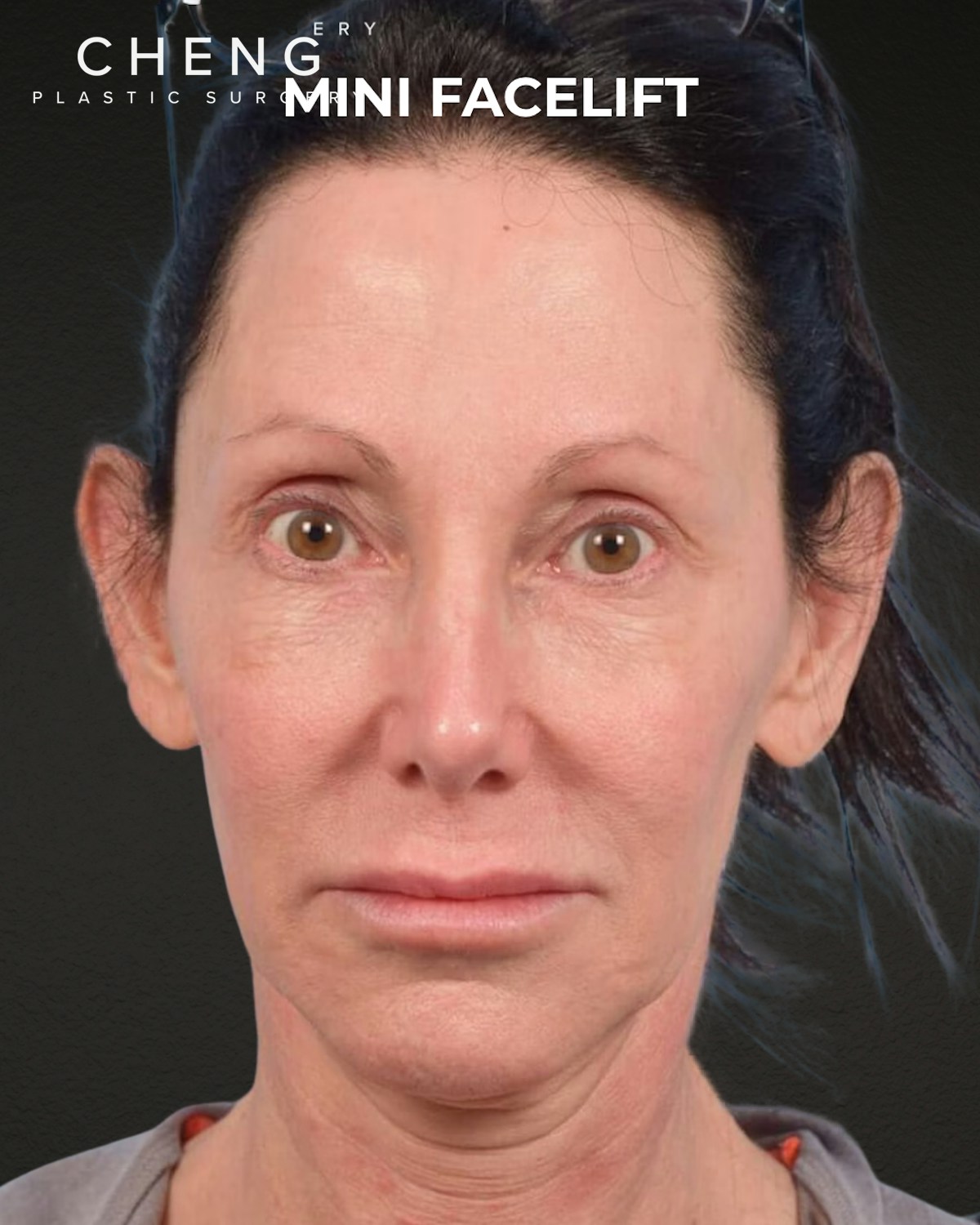 Facelift Before & After Gallery - Patient 325352 - Image 5