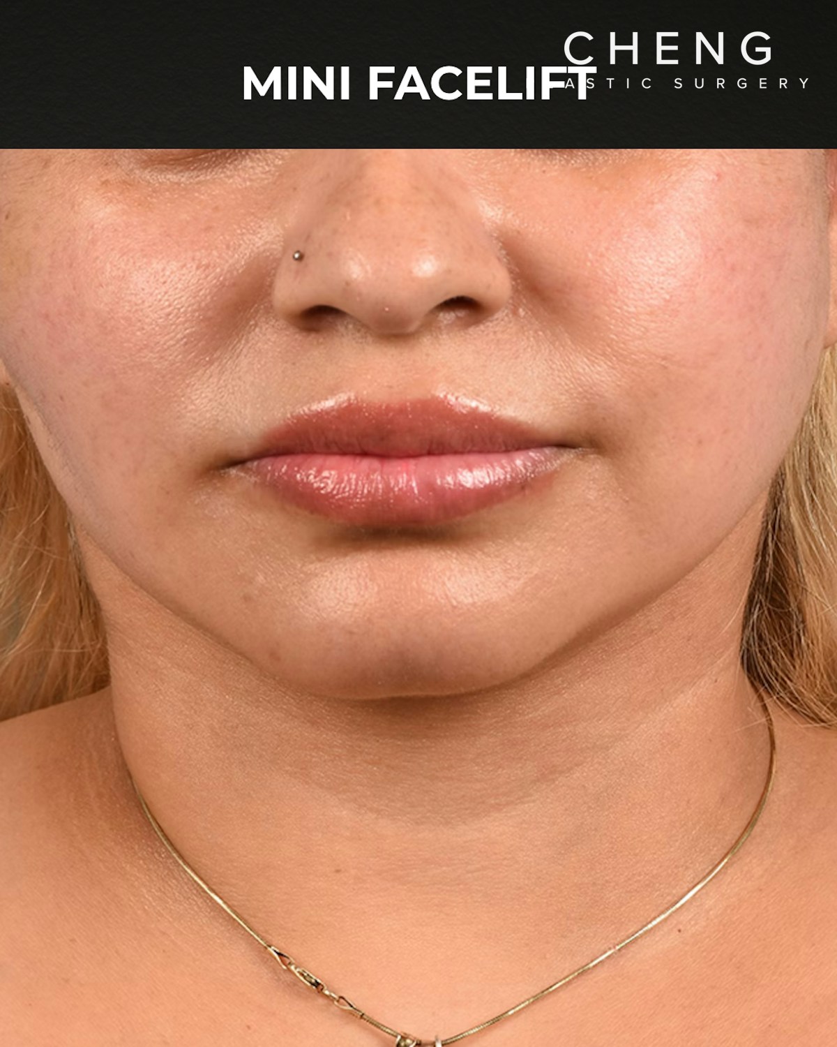Facelift Before & After Gallery - Patient 508752 - Image 2