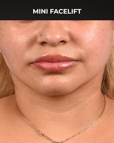 Facelift Before & After Gallery - Patient 508752 - Image 2